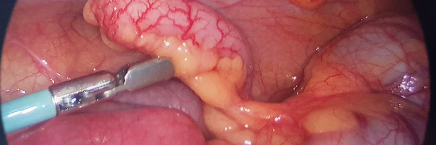 Gall Bladder Surgery